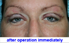 plastic-surgery-blepharoplasty